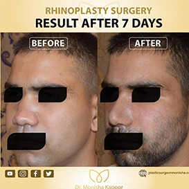 rhinoplasty-img10